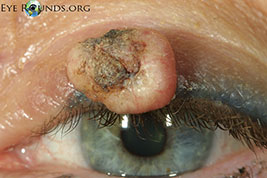 keratoacanthoma