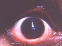 keratoconus with apical scarring
