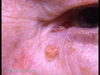 keratotic lesions of lid