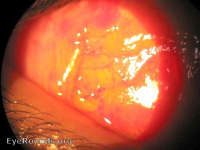 conjunctival laceration