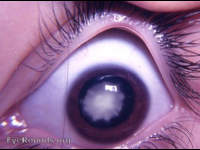 Lamellar cataract / Zonular cataract