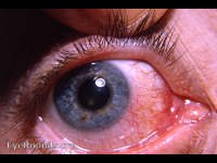 lash entrapped in superior punctum