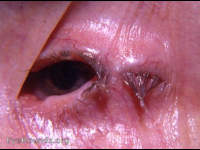 lateral tarsorraphy left eye following trigeminal section for tic douloureux