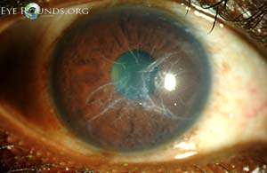 Lattice Corneal Dystrophy