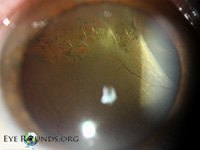 Lattice degeneration of peripheral retina