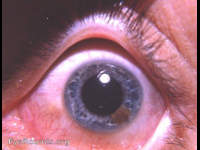 iris lesion- leiomyoma or nevus
