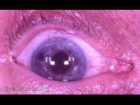 Leiske IOL - a part of the intraocular lens history