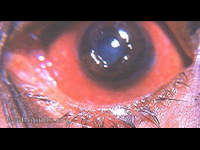 lens tamponade of corneal defect