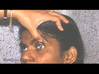 smallpox: leukoma, left eye