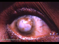 leukomatous scar due to hypopyon ulcer with perforation.