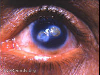 leukomatous corneal ulcer scars with fatty infiltration