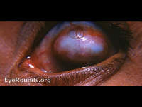 smallpox: staphlyoma of the cornea, vascularized
