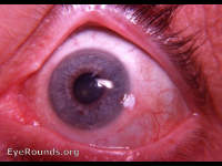 dyskeratosis/ Bowen's disease/ carcinoma in situ