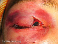 lid laceration - full thickness
