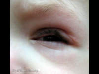 neurofibromatosis type 1 (NF-1) S-Shaped Ptosis
