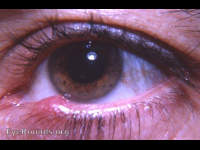lid margin lesion