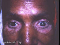 post-op lid repair for trichiasis. vitiligo of lids