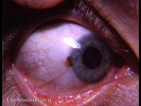 pigmented nevus of limbus