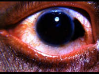 limbal conjunctival nevus