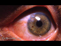 cyst at limbus following pterygium surgery