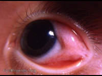lipodermoid / dermolipoma