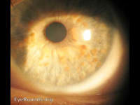 neurofibromatosis type 1 (NF-1) Lisch Nodules