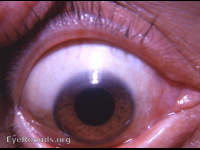 luxated lens