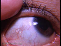 lymphangiectasia conjunctivae