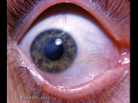 macula of the cornea vs nebula and leukoma