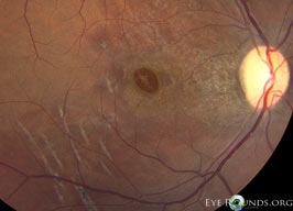 macular hole after blunt force trauma
