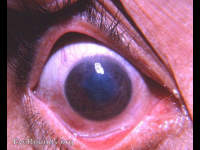 corneal macular scar