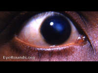 macular corneal scar