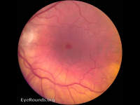 Macular Hole