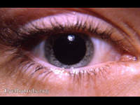 Varicella/ chickenpox, madarosis (LL)