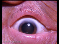 madarosis / milphosis