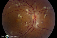Malignant hypertension