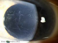 Epithelial basement membrane dystrophy