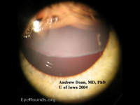Marfan's syndrome, lens subluxation