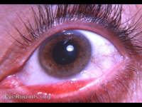 acute meibomianitis marginalis