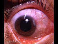 marginal keratitis with rosacea