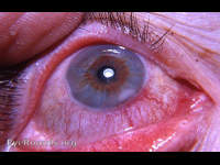 marginal keratitis