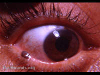 Nevus (Pigmented nevus of lower lid margin)