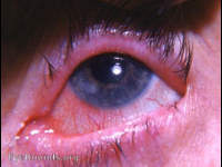 keratitis: allergic or autoimmune basis