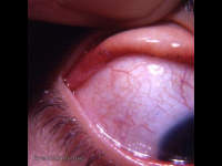Pigmentation of conjunctiva by mascara