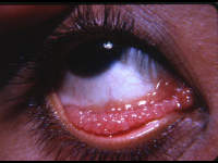 florid follicular formation in acute trachoma