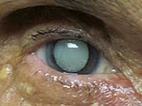 Mature Cataract