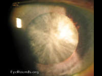 Mature Cataract