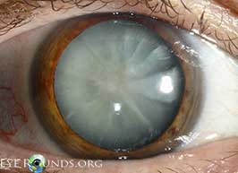 Mature cortical cataract
