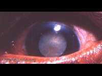 Mature corticonuclear cataract