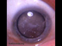 Mature cataract entering the hypermature stage
